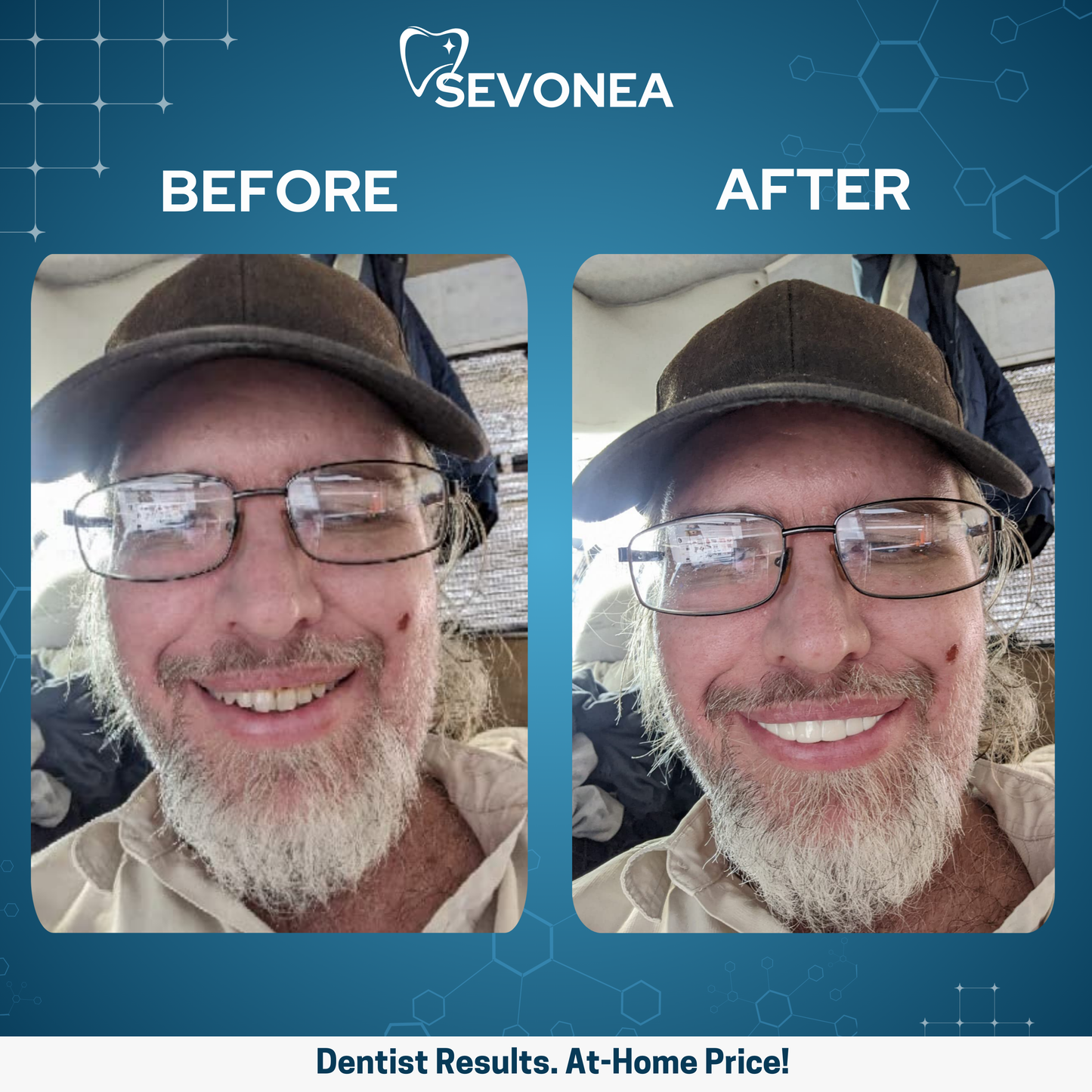 SmileShine™ Dental Veneers