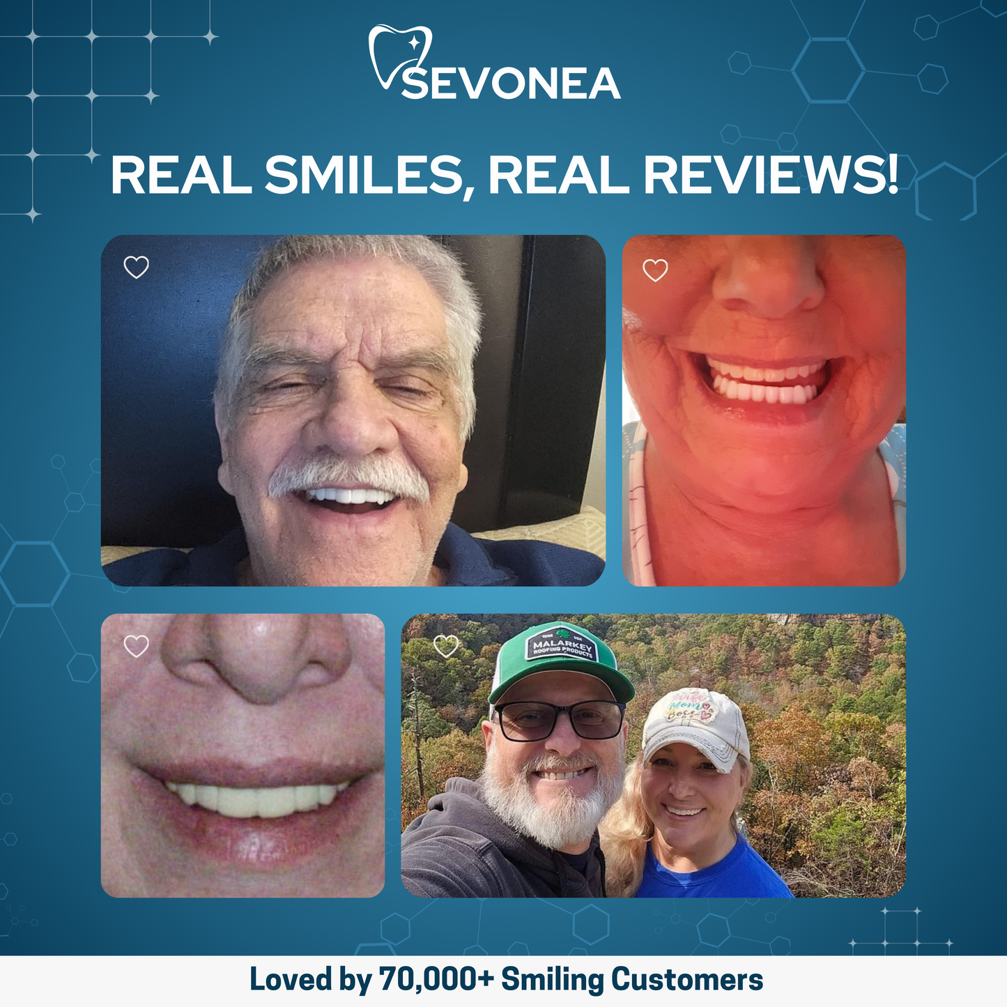 SmileShine™ Dental Veneers