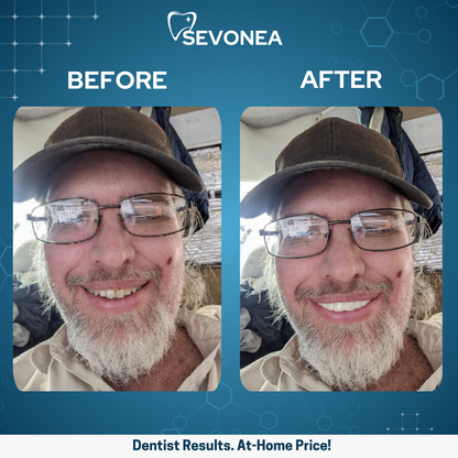 SmileShine™ Dental Veneers