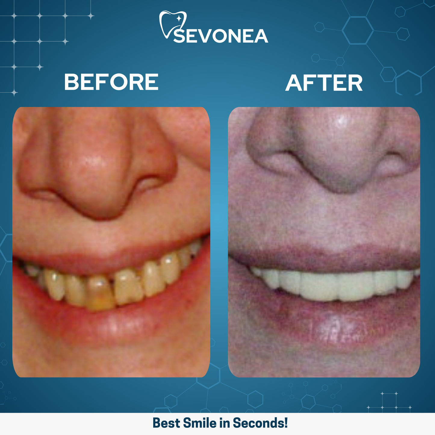 SmileShine™ Dental Veneers