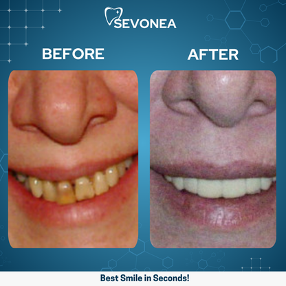 SmileShine™ Dental Veneers